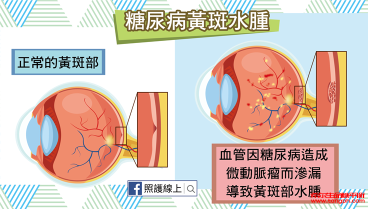 糖尿病视网膜病变是怎样的